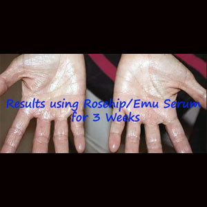 Rosehip & Emu Serum Can Help With Skin Issues 1 oz bottles Scented or Non Scented